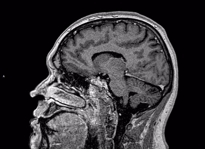 Brain — Accelerated