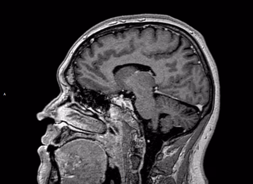 Brain — Standard