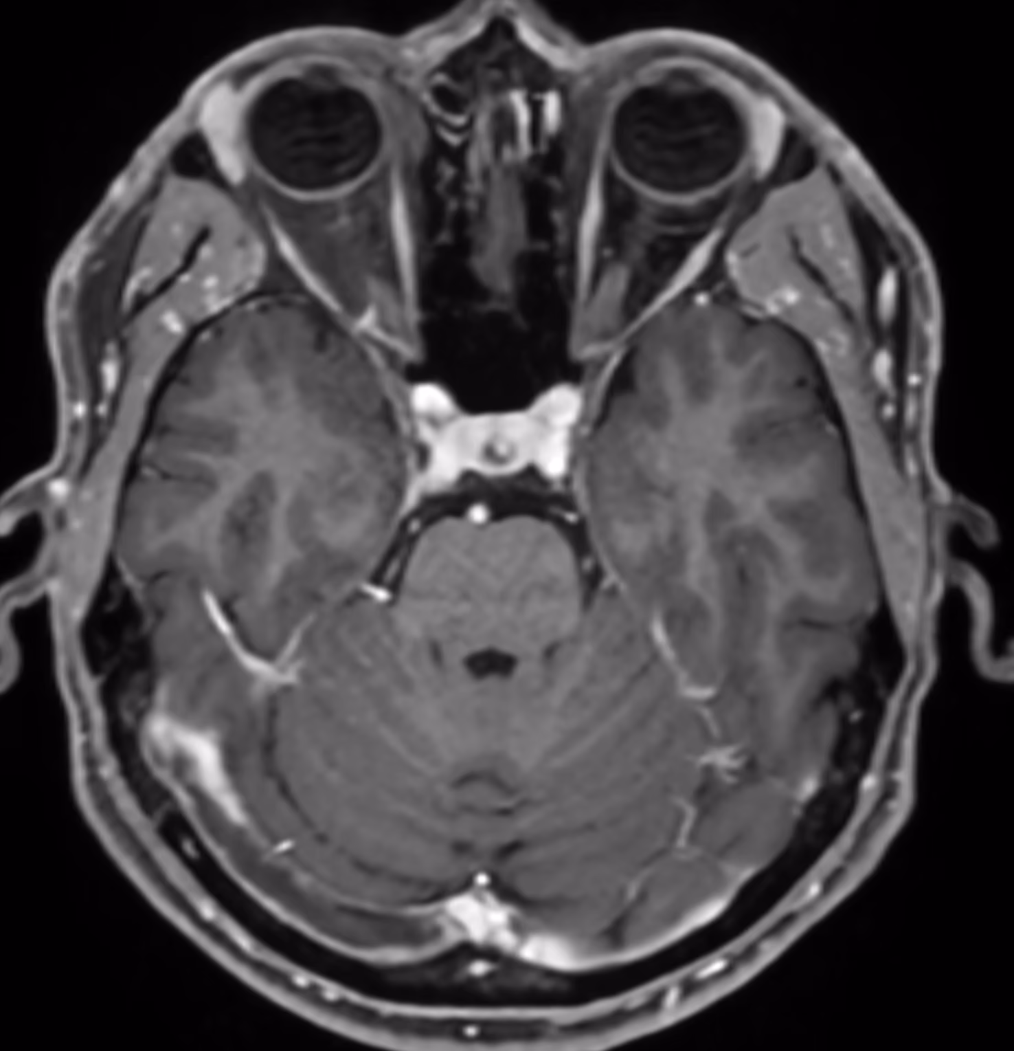 Neuro cases — CVST · MPRAGE