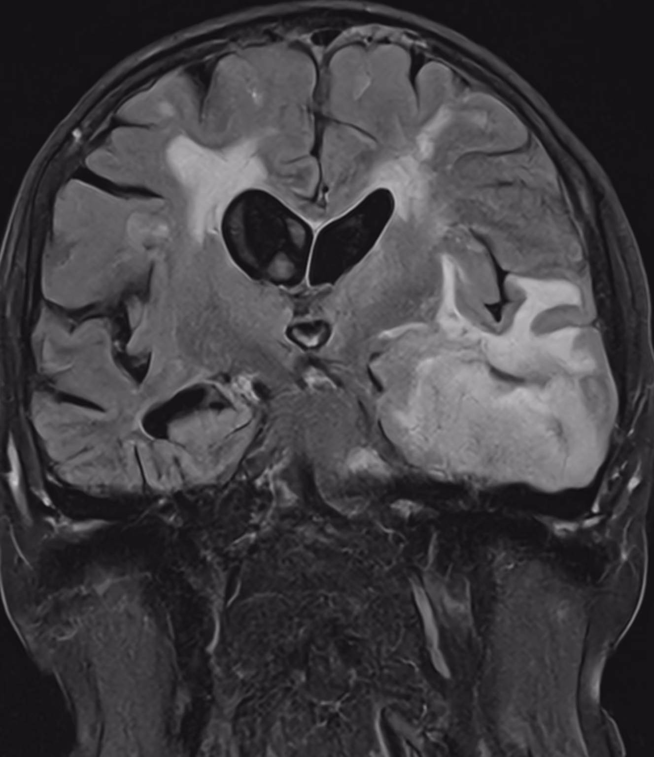 Neuro cases — Glioblastoma · coronal FLAIR