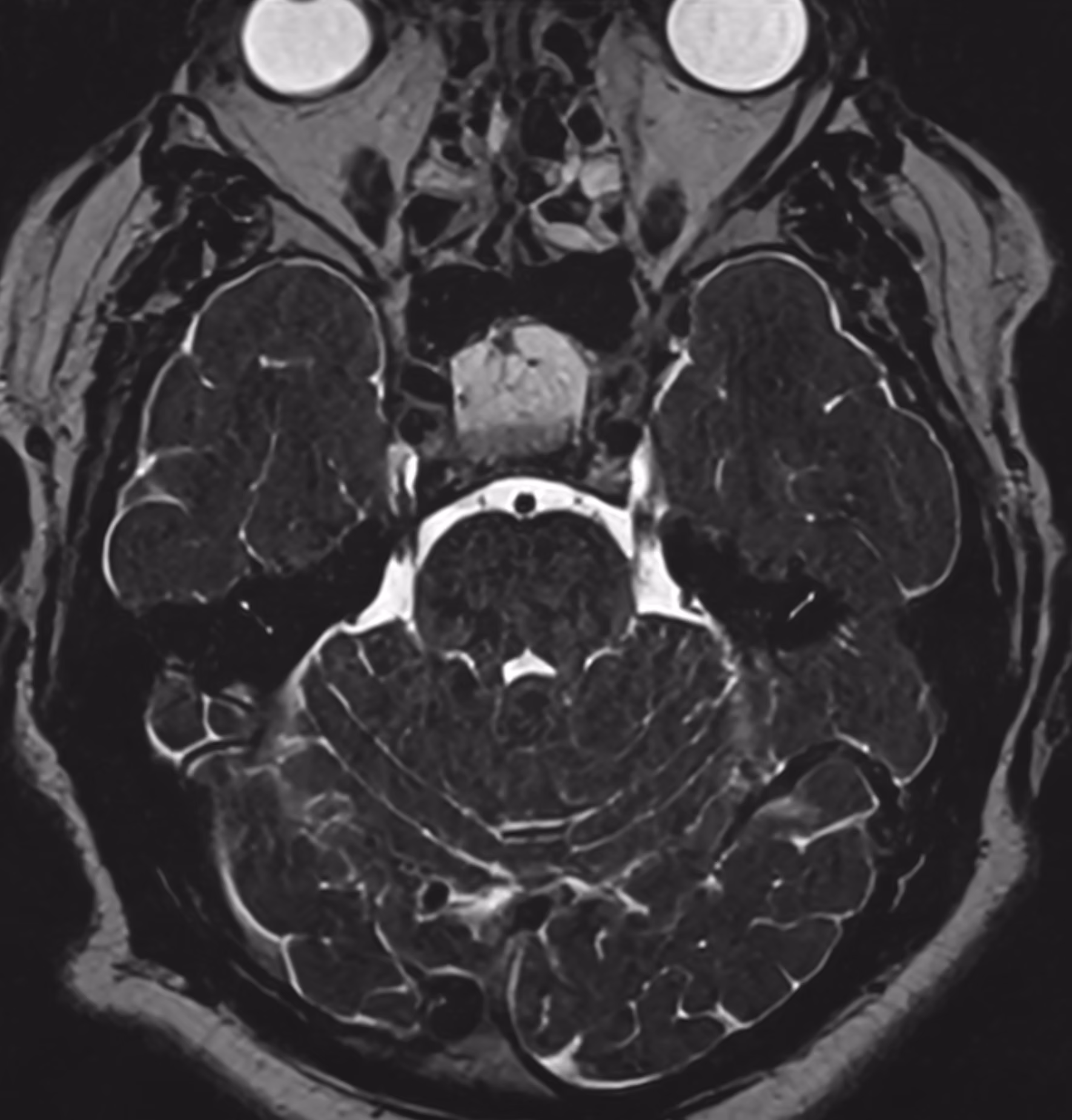 Neuro cases — Rathke's cleft cyst · SPACE 0.4 mm
