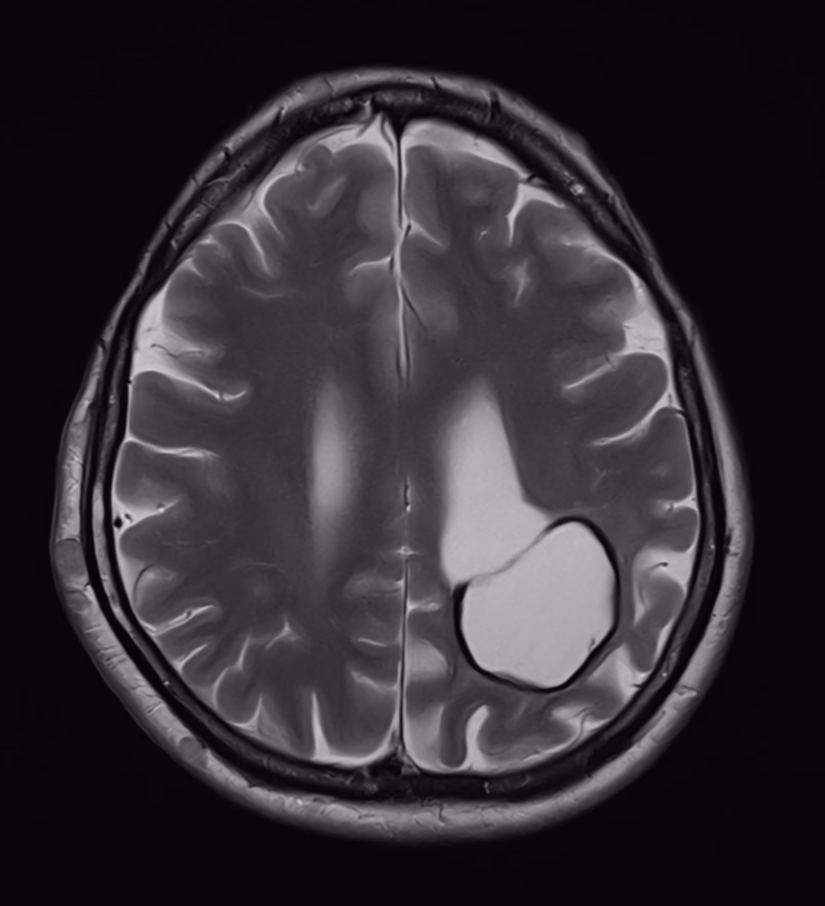 Neurofibromatosis
