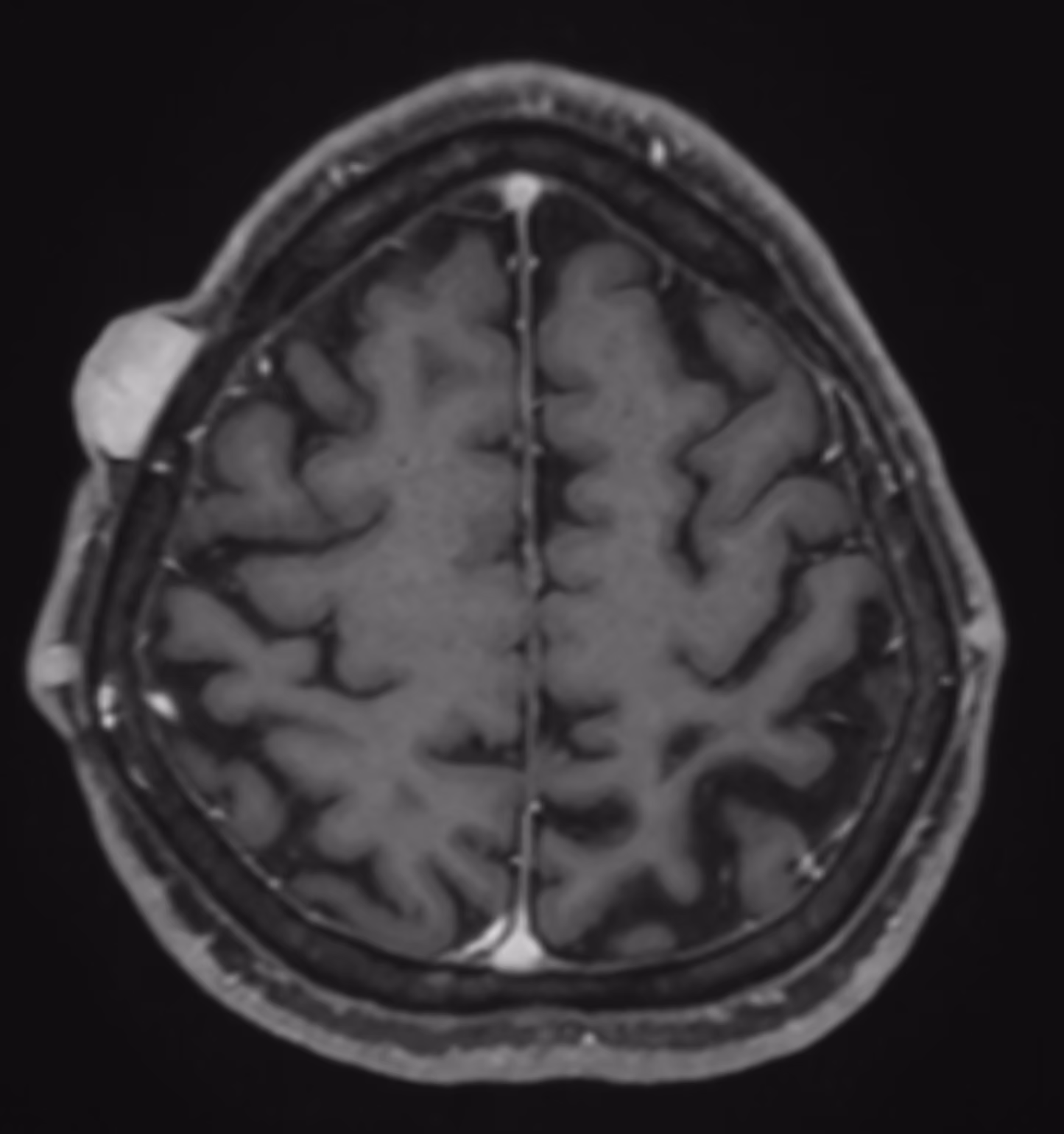 Neurofibromatosis