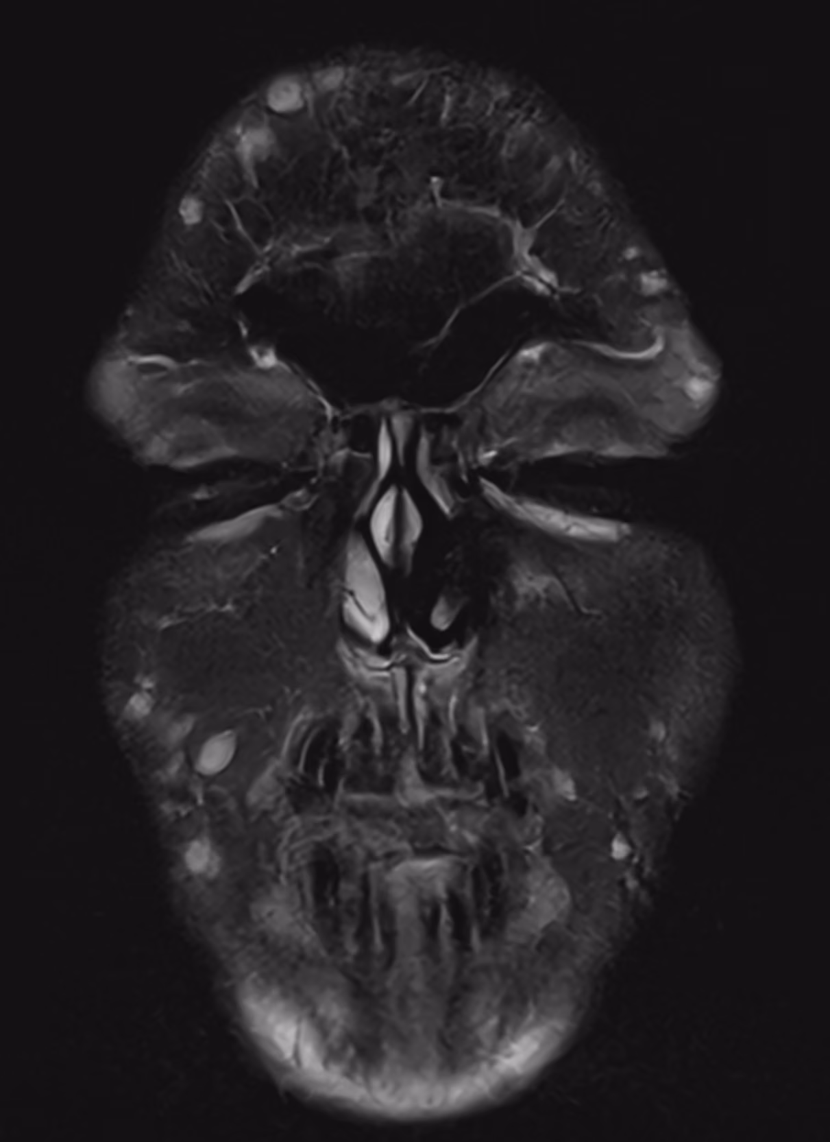 Neurofibromatosis