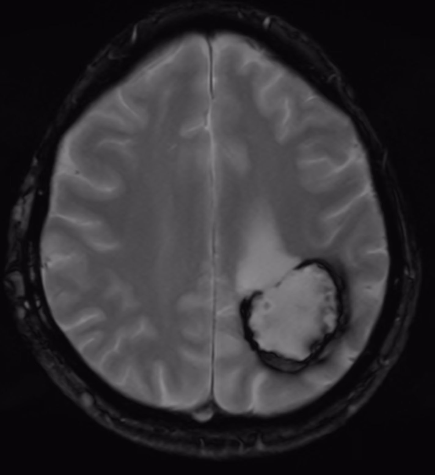 Neurofibromatosis