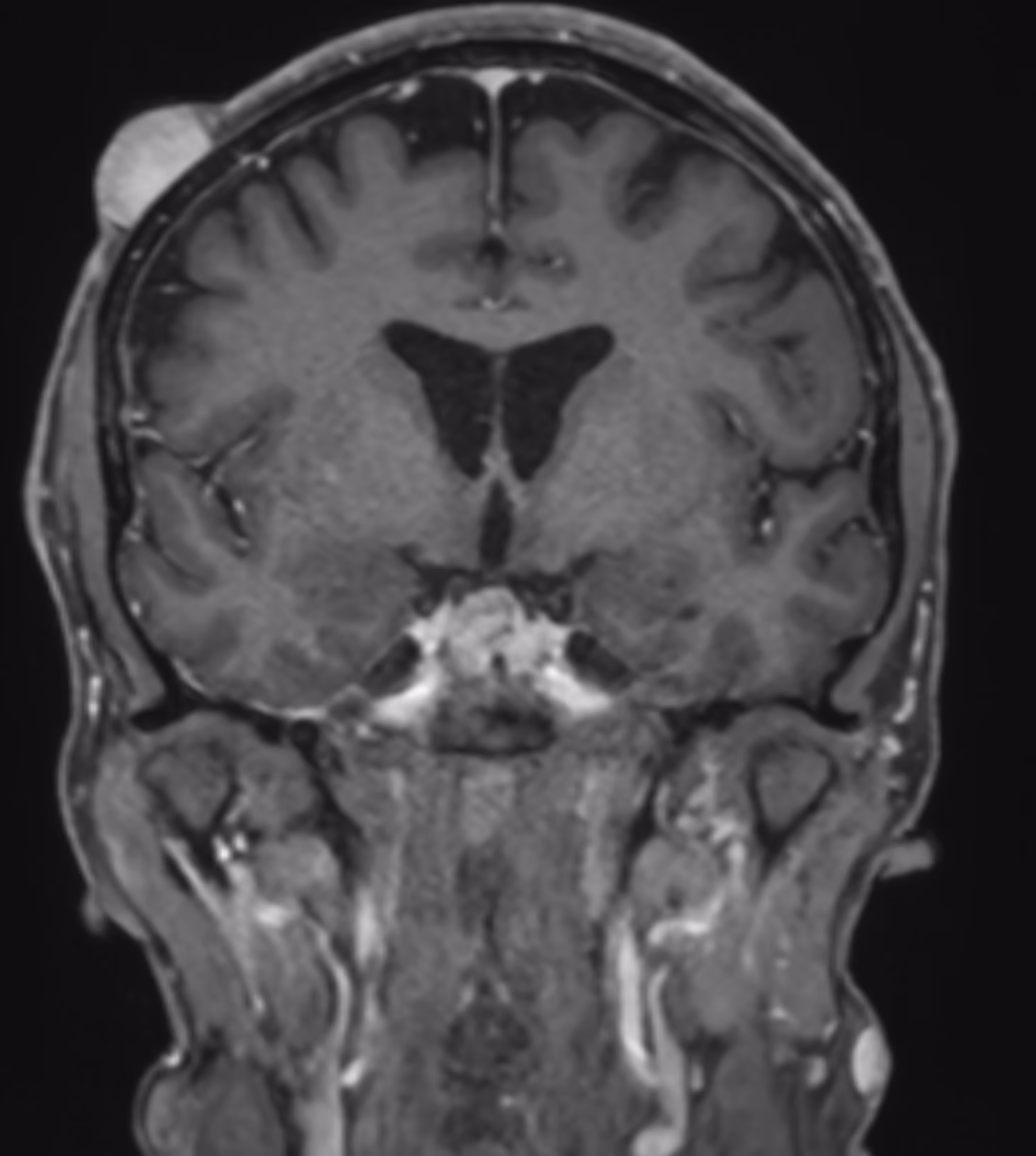 Neurofibromatosis
