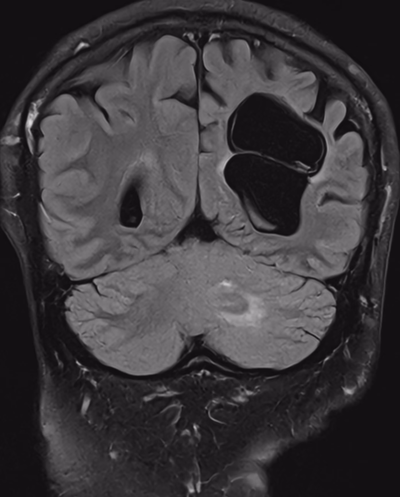Neurofibromatosis