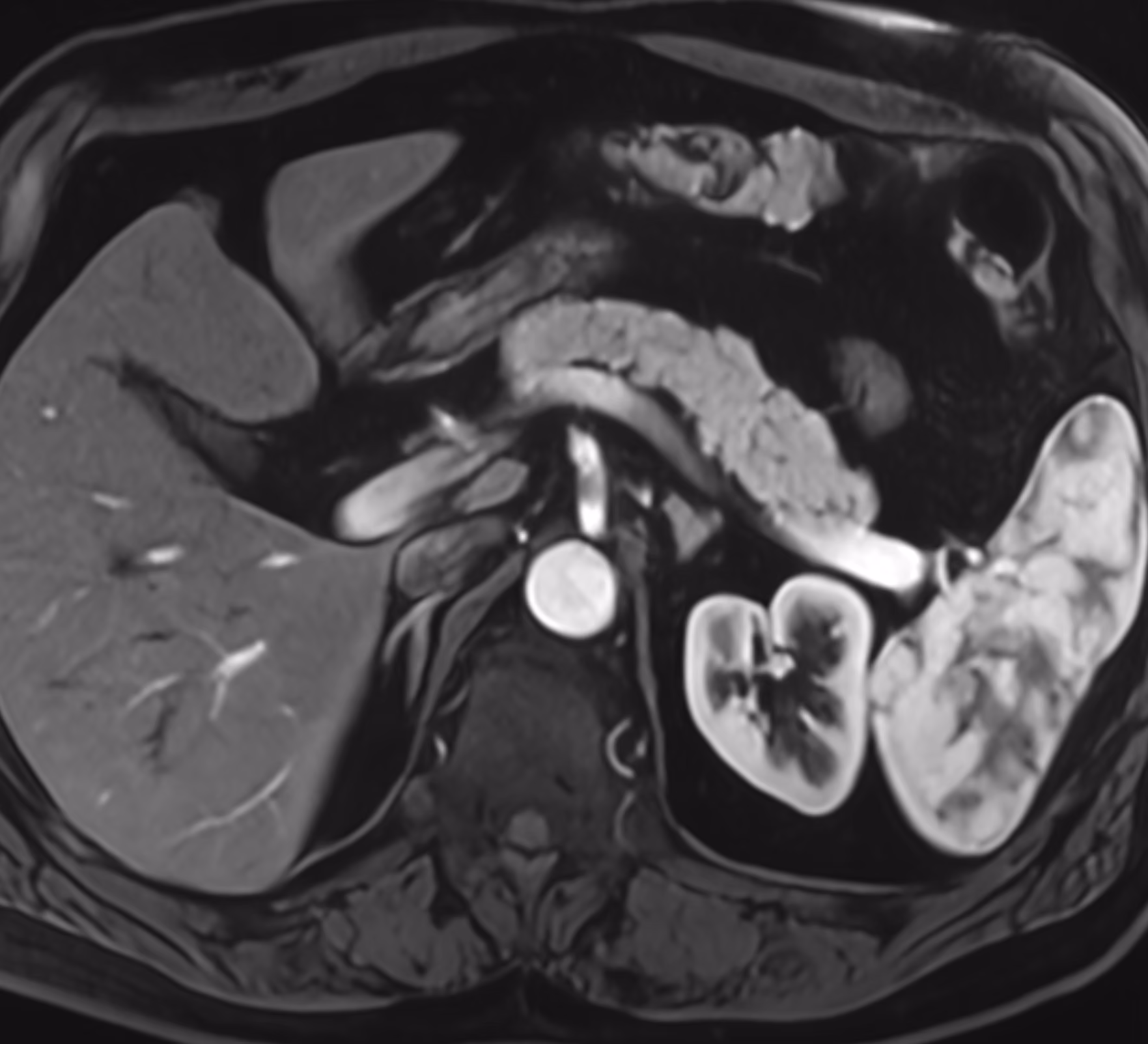 3D, vessels, and contrast-enhanced studies — Breath-hold 3D ce-VIBE