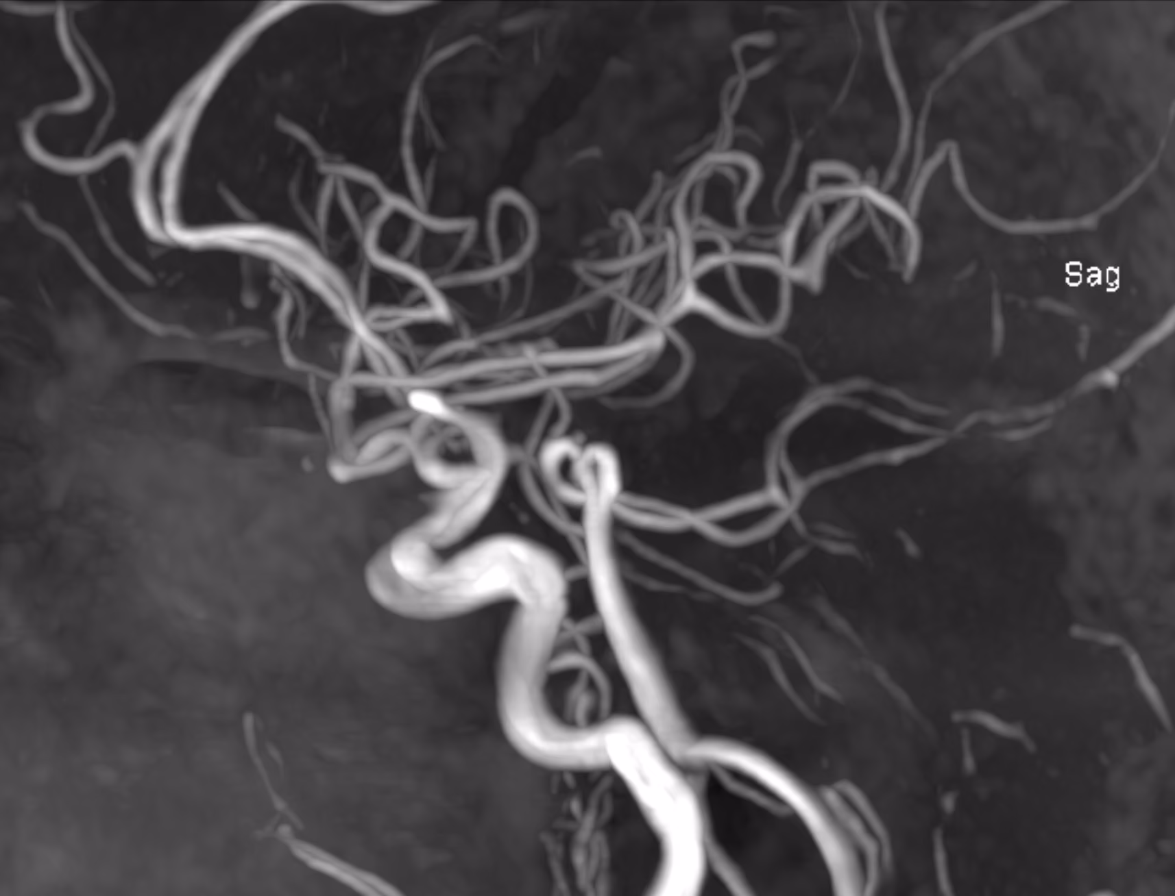 3D, vessels, and contrast-enhanced studies — Arterial TOF