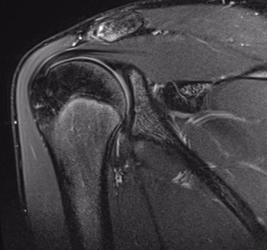 Shoulder, PASTA lesion — Amira · SMS