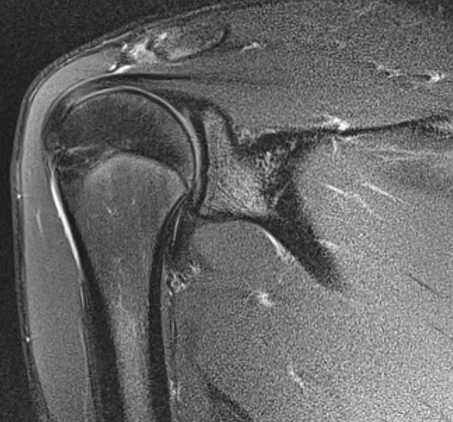 Shoulder, PASTA lesion — Avanto