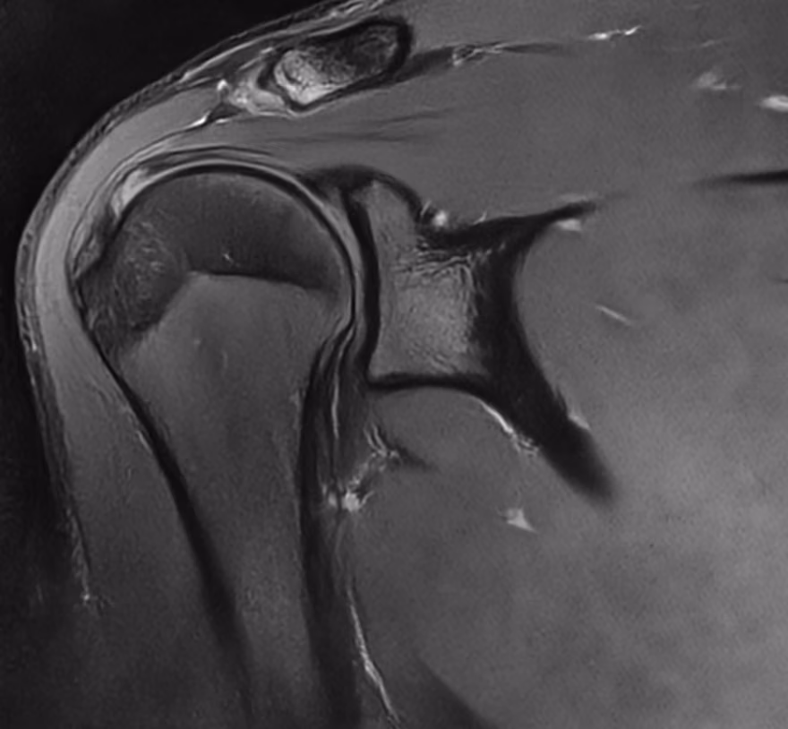 Shoulder, PASTA lesion — Avanto · SwiftMR