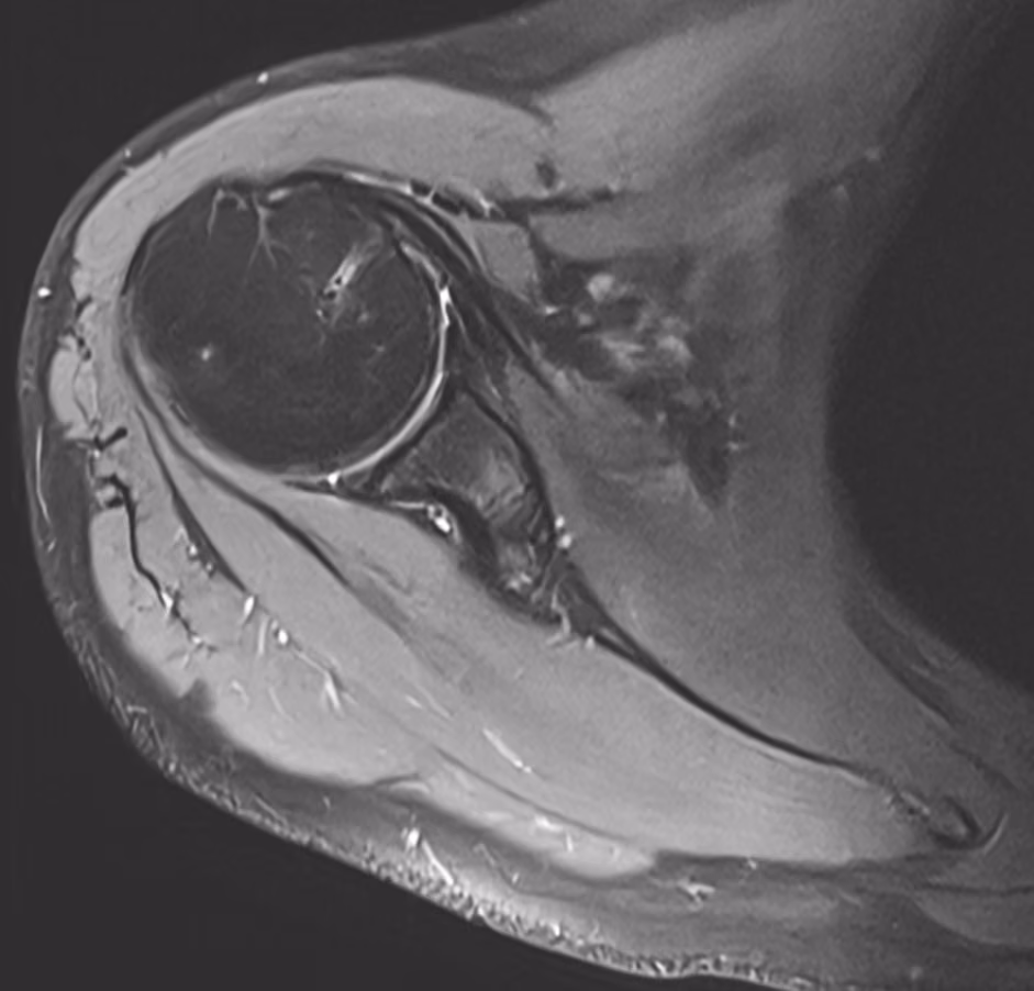 Shoulder, Subscapularis rupture — Altea · SMS + DRB