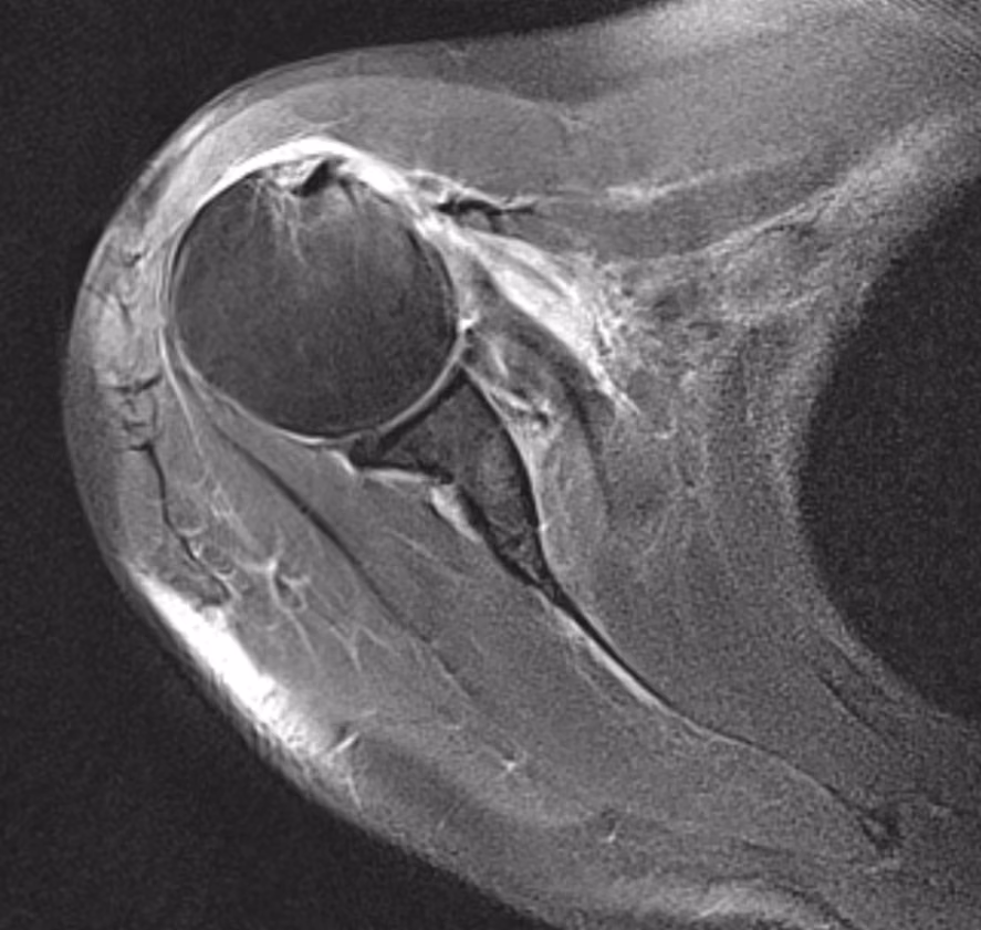 Shoulder, Subscapularis rupture — Avanto