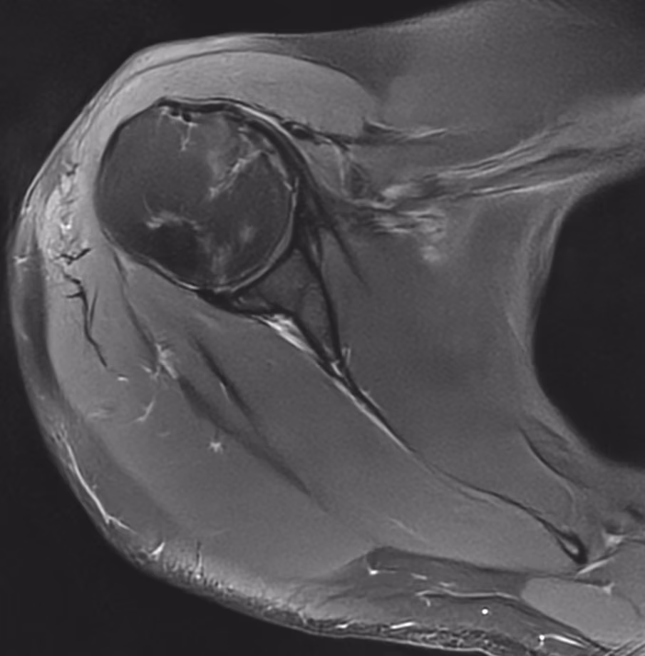 Shoulder, Subscapularis rupture — Avanto · SwiftMR