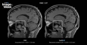 1.5T vessel wall MRI comparing acquired 0.6 × 0.6 × 1.0 mm images with SwiftMR reconstruction at 0.26 × 0.26 × 0.5 mm for finer anatomic detail.