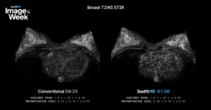 Breast T2-weighted STIR MRI comparing a conventional 4:25 acquisition with SwiftMR at 1:36, a 64% scan time reduction with higher reconstructed resolution.