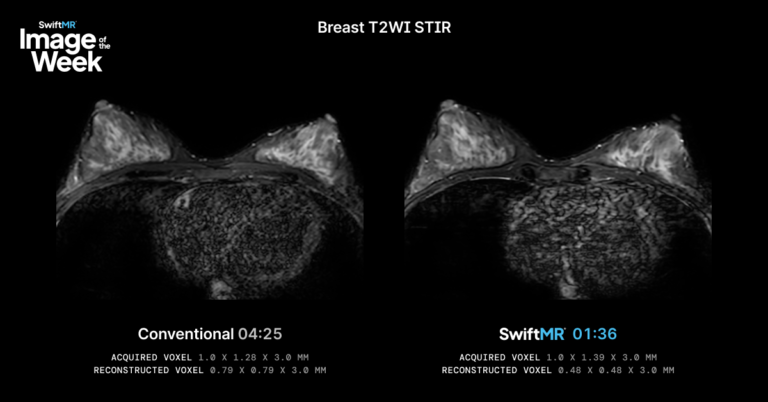 AI Deep Learning Reconstruction on Breast T2WI STIR image