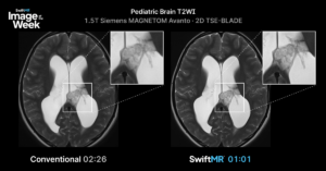 Pediatric brain T2-weighted MRI on a 1.5T Siemens MAGNETOM Avanto comparing a conventional 2:26 acquisition with SwiftMR at 1:01, a 58% reduction.