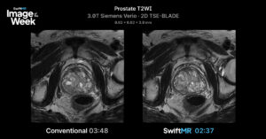 Axial prostate T2-weighted MRI on a 3T Siemens Verio comparing conventional 3:48 scan time with SwiftMR 2:37, a 31% reduction.