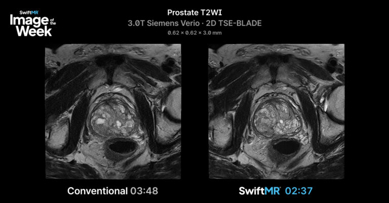 Axial prostate T2-weighted MRI on a 3T Siemens Verio comparing conventional 3:48 scan time with SwiftMR 2:37, a 31% reduction.
