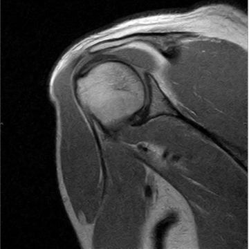 Coronal PD Shoulder, Hitachi AIRIS ELITE 0.3T — standard acquisition, scan time 4:00