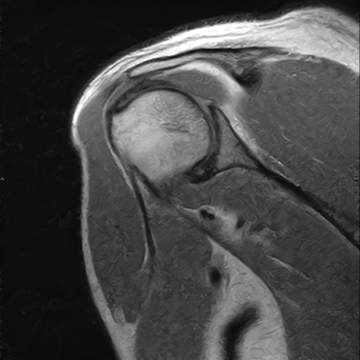 Coronal PD Shoulder, Hitachi AIRIS ELITE 0.3T — SwiftMR acquisition, scan time 1:46, 56% faster