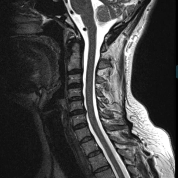 Sagittal cervical spine MRI, conventional scan