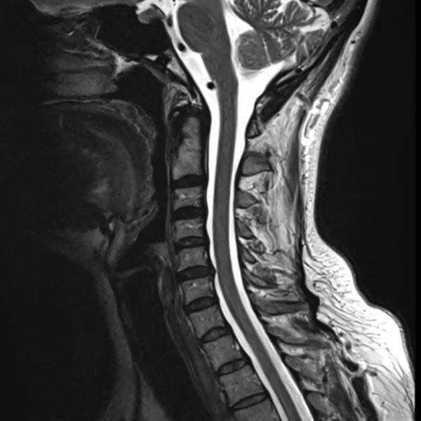 Sagittal cervical spine MRI, SwiftMR scan