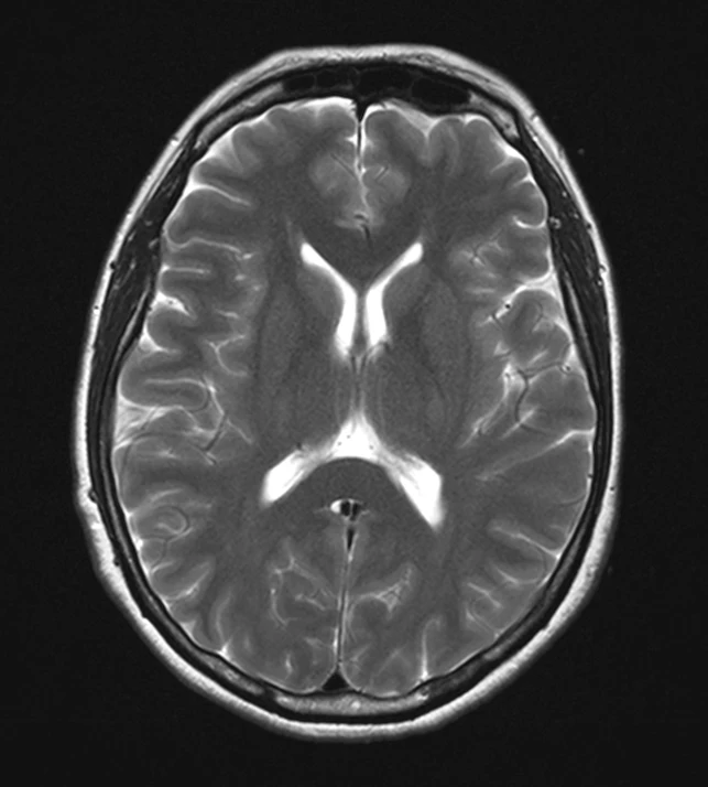 Axial T2 brain MRI on a Siemens Aera 1.5T, conventional scan