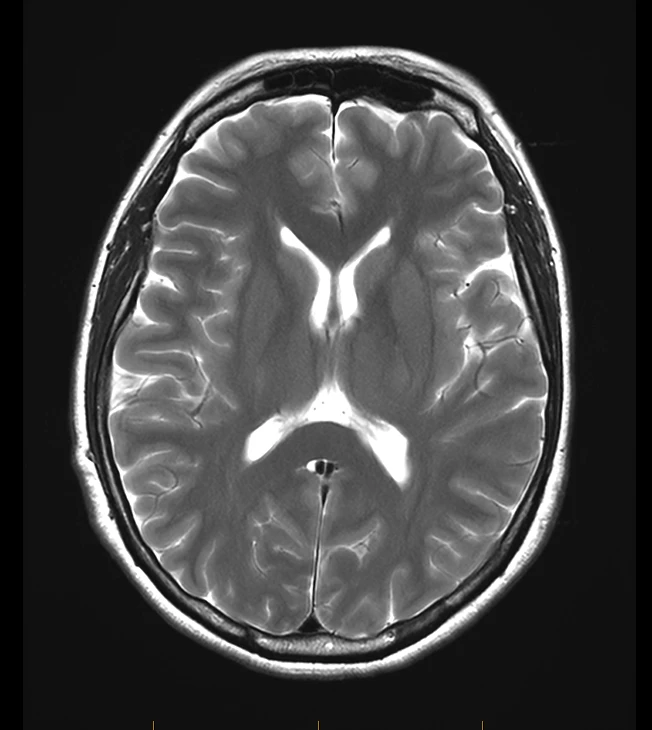 Axial T2 brain MRI on a Siemens Aera 1.5T, SwiftMR scan