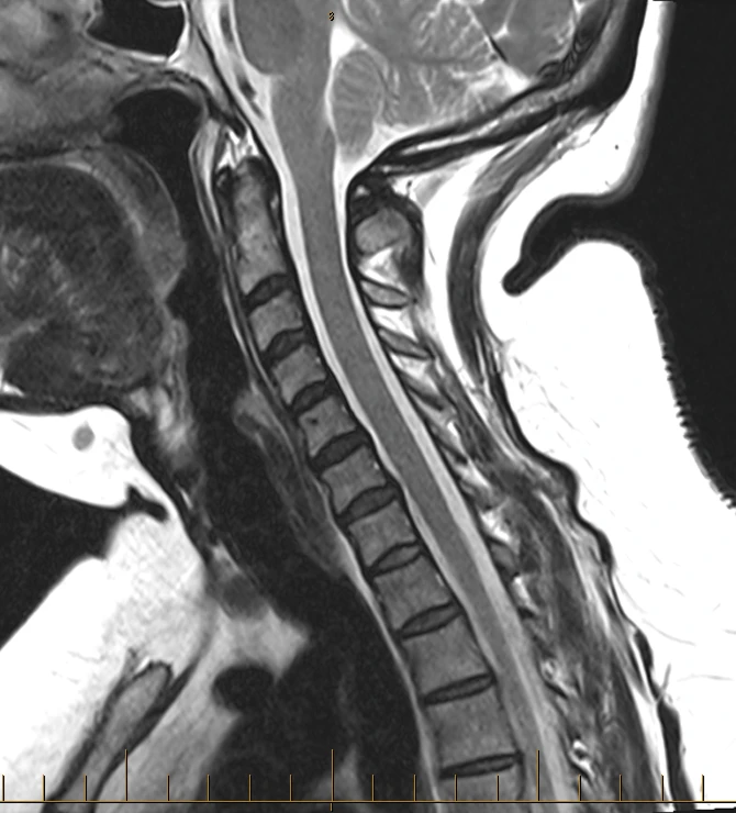 Sagittal cervical spine MRI on a Siemens Aera 1.5T, conventional scan