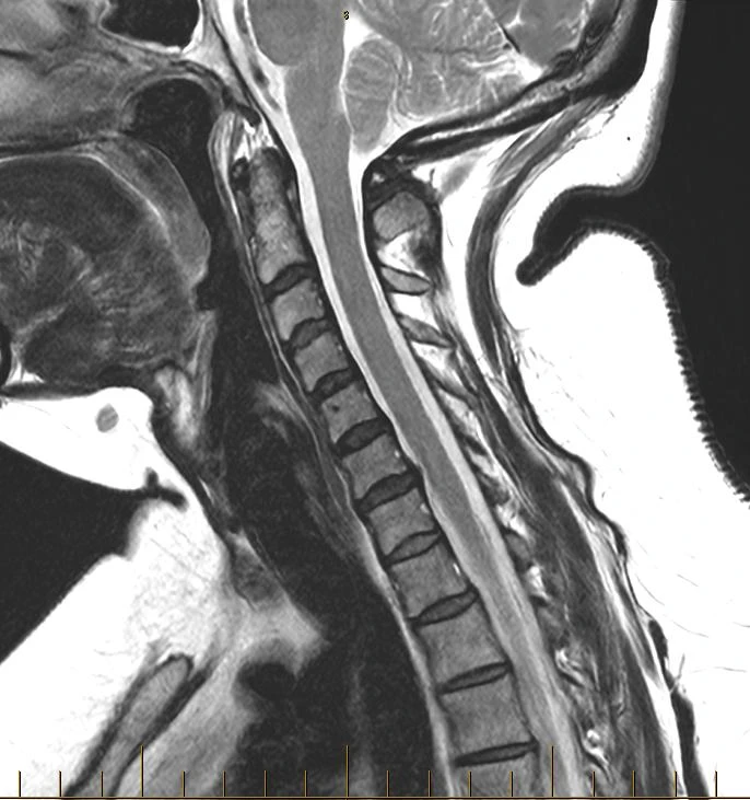 Sagittal cervical spine MRI on a Siemens Aera 1.5T, SwiftMR scan