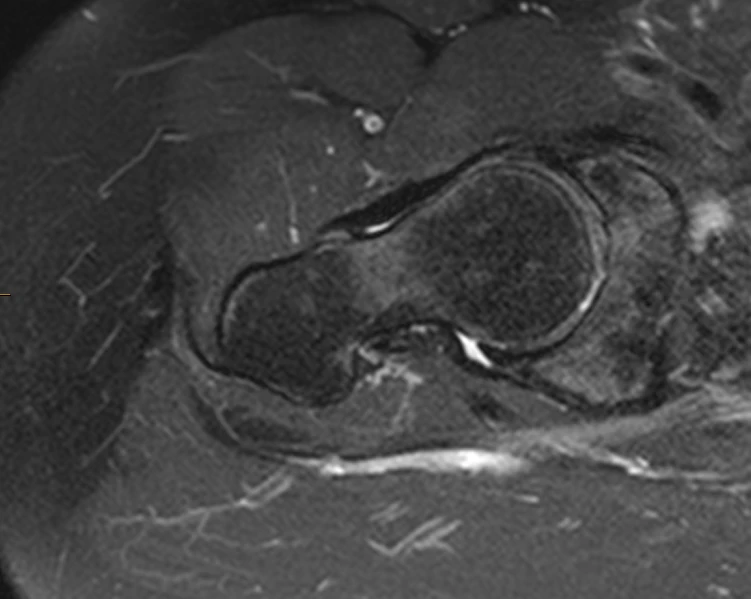 Hip MRI on a Siemens Aera 1.5T, conventional scan