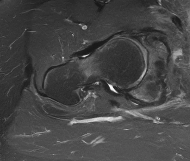 Hip MRI on a Siemens Aera 1.5T, SwiftMR scan