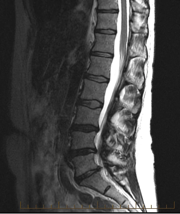 Sagittal lumbar spine MRI on a GE Optima 1.5T, conventional scan
