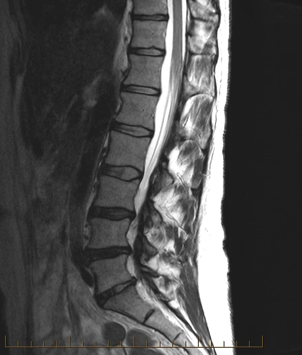 Sagittal lumbar spine MRI on a GE Optima 1.5T, SwiftMR scan