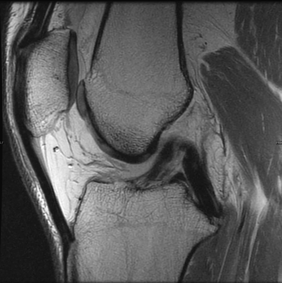 Sagittal proton density knee MRI on a GE Signa EXCITE 1.5T, conventional scan