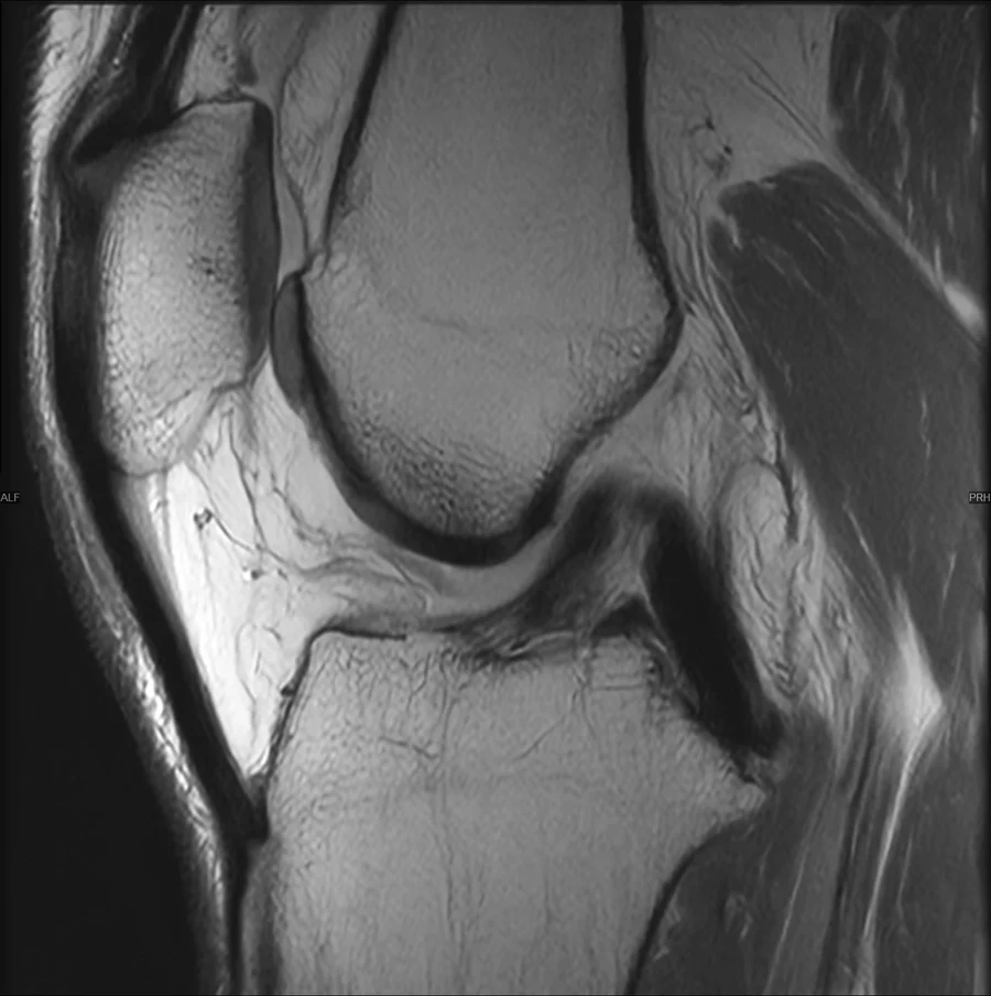 Sagittal proton density knee MRI on a GE Signa EXCITE 1.5T, SwiftMR scan