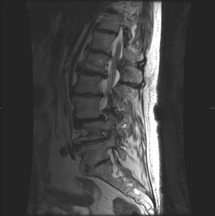 Sagittal T2 lumbar spine MRI on a GE Signa EXCITE 1.5T, conventional scan