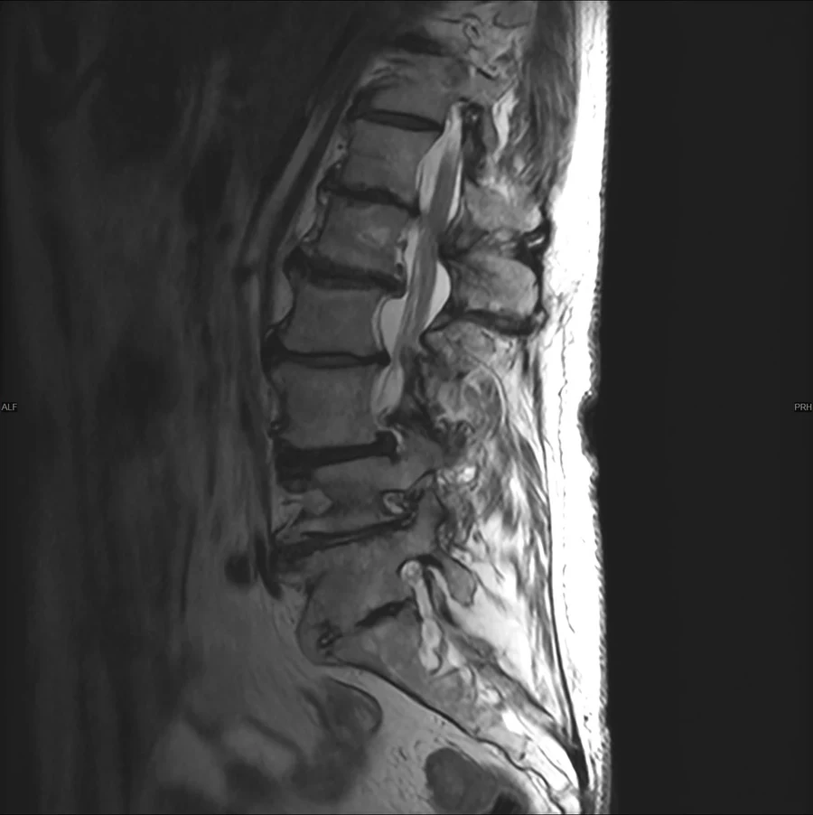 Sagittal T2 lumbar spine MRI on a GE Signa EXCITE 1.5T, SwiftMR scan