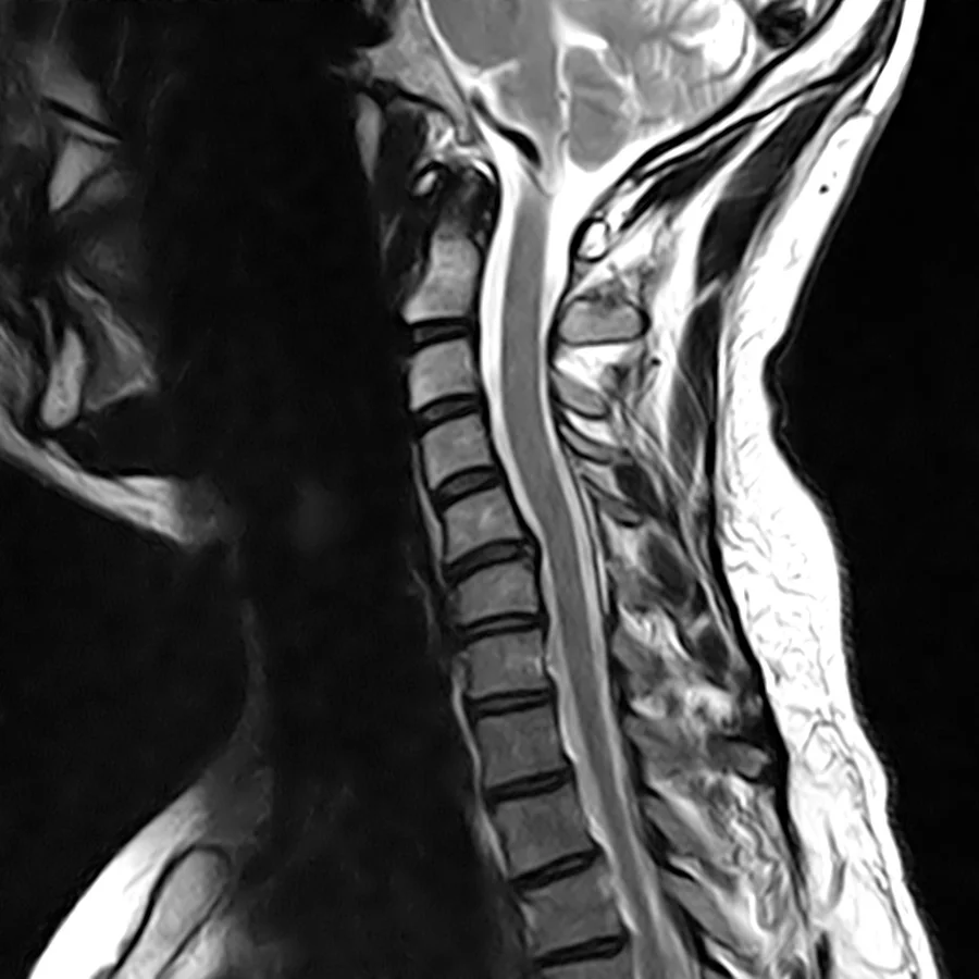 Sagittal T2 cervical spine MRI on a Canon Vantage Orion 1.5T, conventional scan