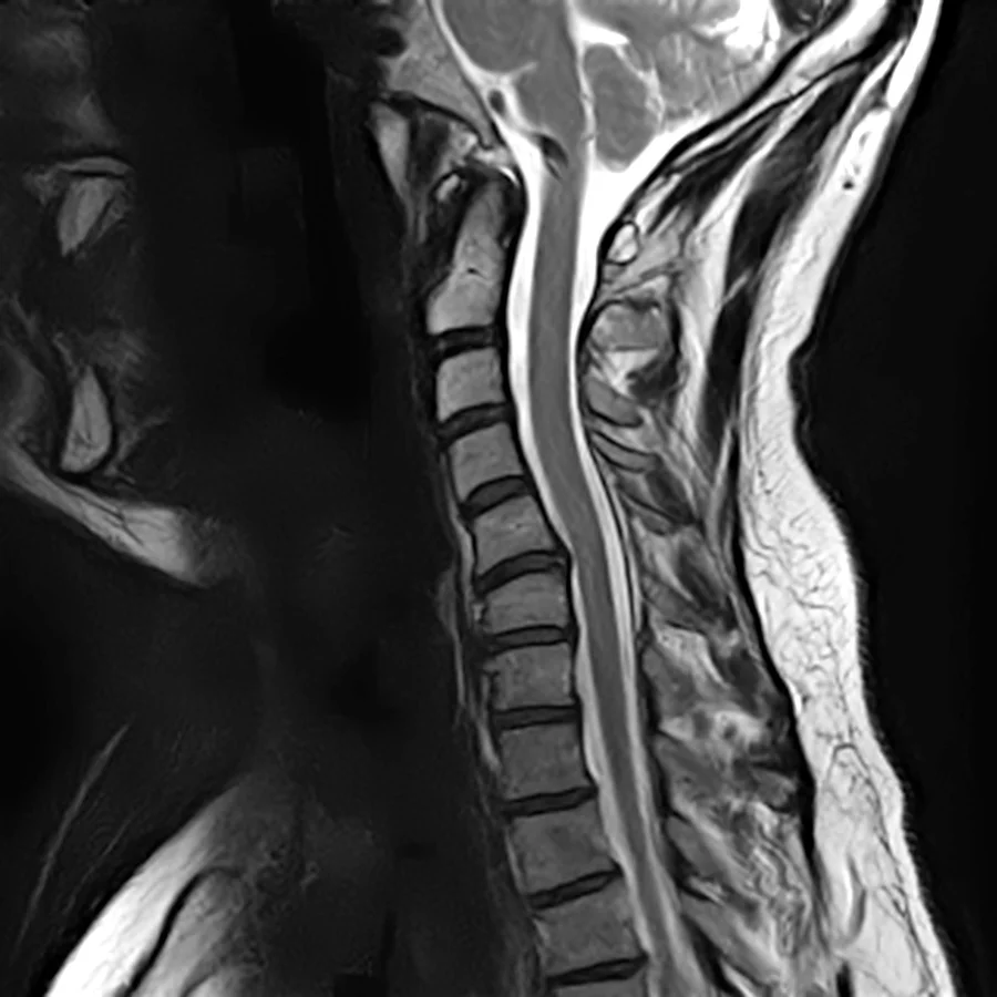 Sagittal T2 cervical spine MRI on a Canon Vantage Orion 1.5T, SwiftMR scan