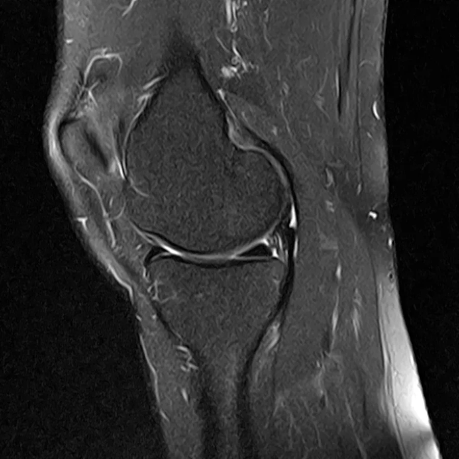 Sagittal T2 fat-saturated knee MRI on a Canon Vantage Orion 1.5T, conventional scan