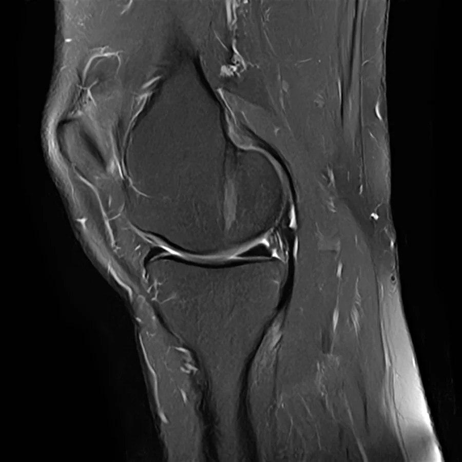 Sagittal T2 fat-saturated knee MRI on a Canon Vantage Orion 1.5T, SwiftMR scan