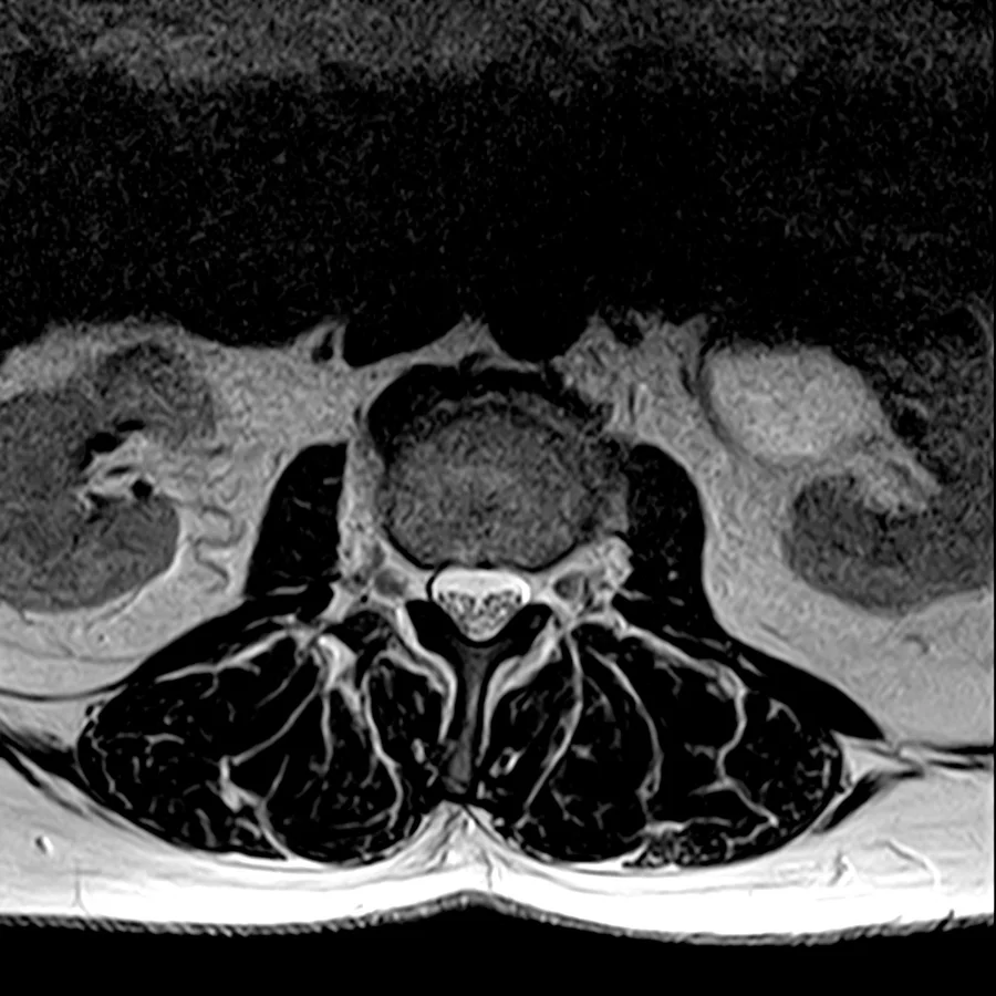 Axial T2 lumbar spine MRI on a Canon Vantage Orion 1.5T, conventional scan