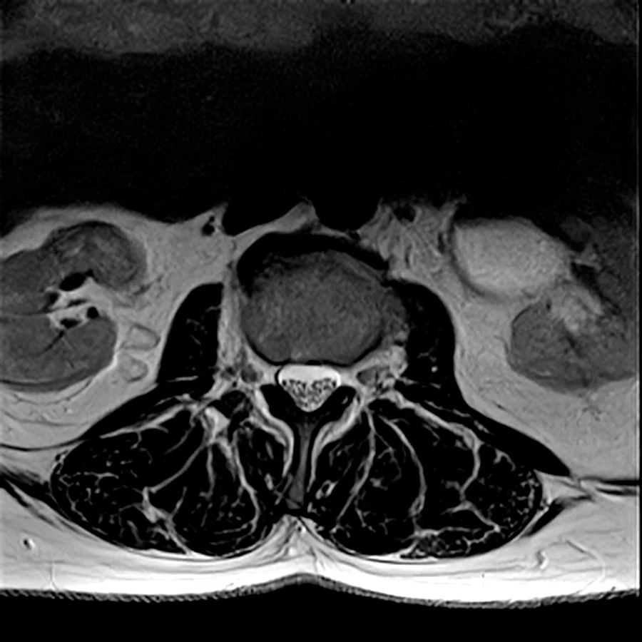 Axial T2 lumbar spine MRI on a Canon Vantage Orion 1.5T, SwiftMR scan