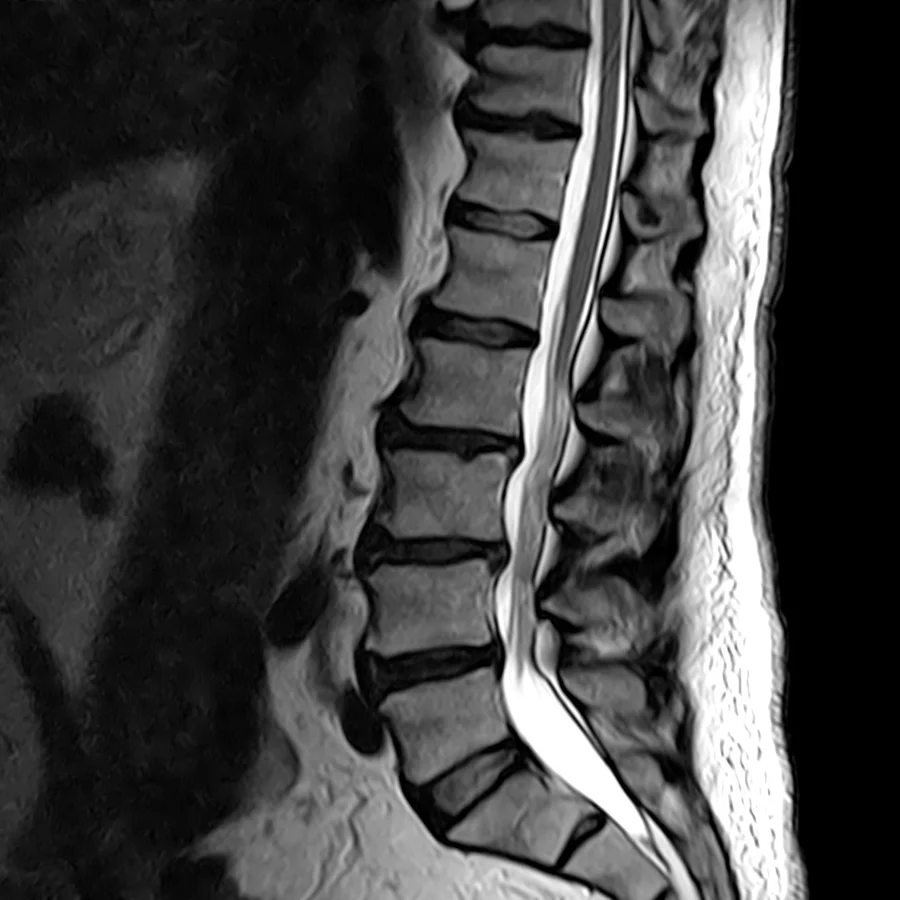 Sagittal T2 lumbar spine MRI on a Canon Vantage Orion 1.5T, conventional scan