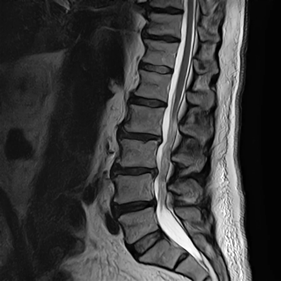 Sagittal T2 lumbar spine MRI on a Canon Vantage Orion 1.5T, SwiftMR scan