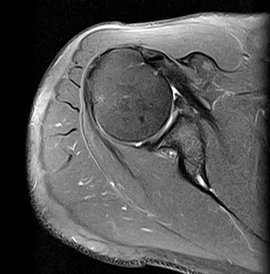Axial proton density fat-saturated shoulder MRI on a Canon Vantage Orion 1.5T, conventional scan